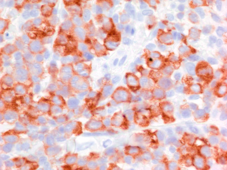 ALK+ Anaplastic Large cell Lymphoma