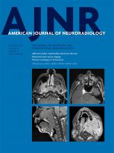 Hemodynamic Characteristics of Ruptured and Unruptured Multiple Aneurysms at Mirror and Ipsilateral Locations