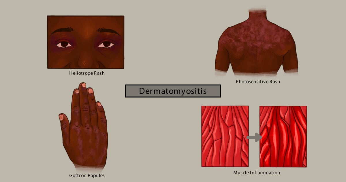 dermatomyositis characteristics