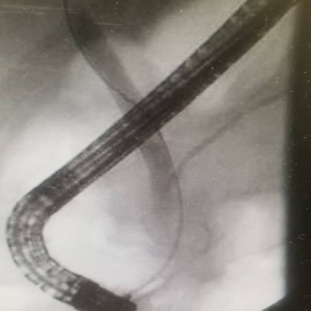 ERCP advanced GI