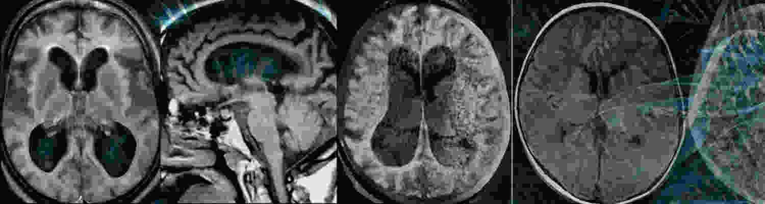 gene-therapy-research-and-therapeutic-strategies-for-tay-sachs-gagliosidosis-disease-miguel-sena-esteves-lab-horae-gene-therapy-research-center.jpg