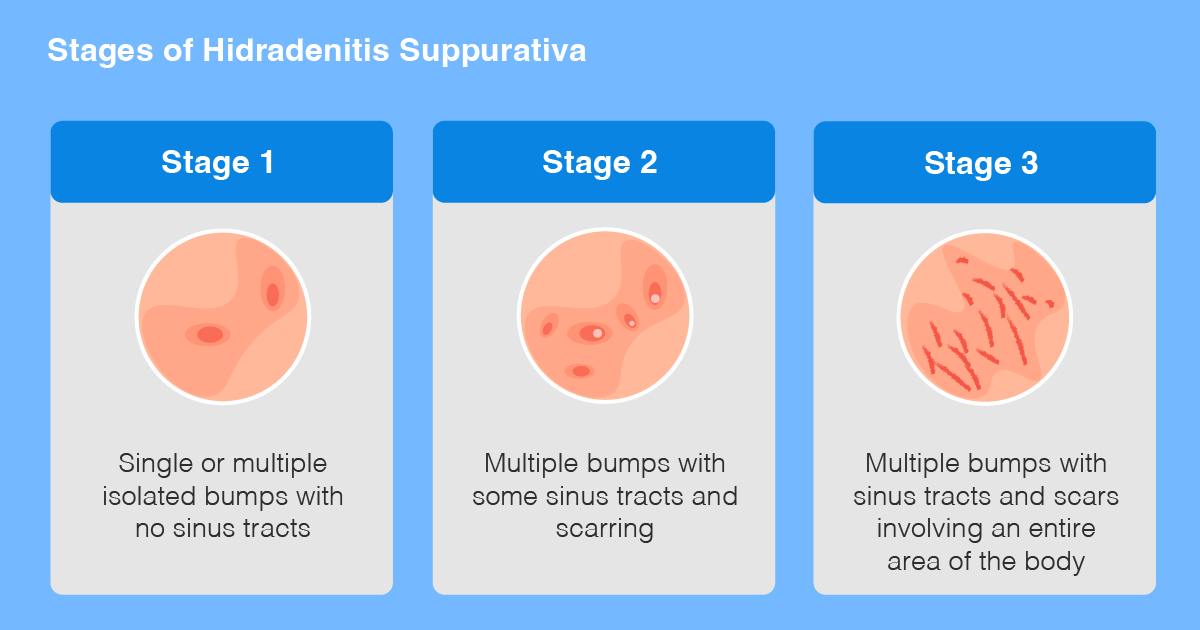 stages-of-hs.png