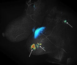 Fast dynamic MRI