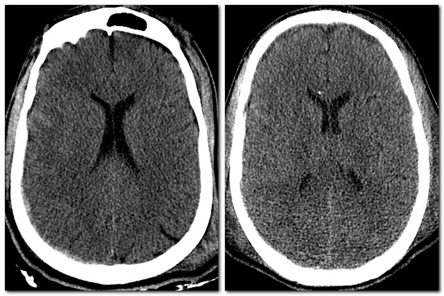 Brain edema