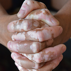 Vitiligo-hands.png