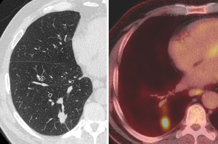 LDCT Lung Cancer Screening Program