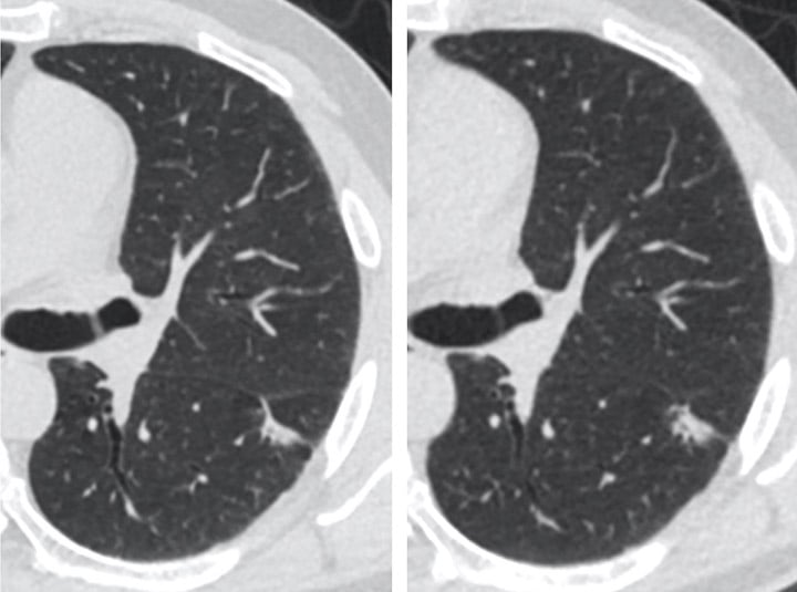 LDCT Lung Cancer Screening Program