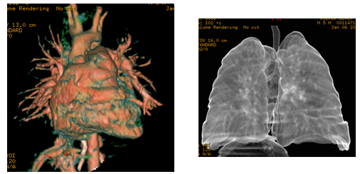 3D reconstruction of a CT scan in a patient with a double aortic arch squeezing the trachea (windpipe) causing him breathing difficulty.