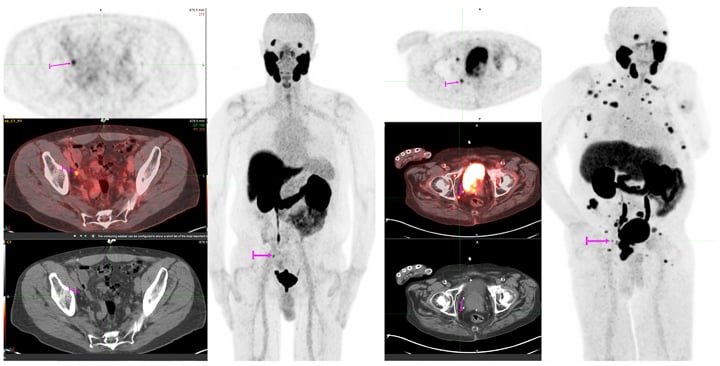 PSMA Tracer Images