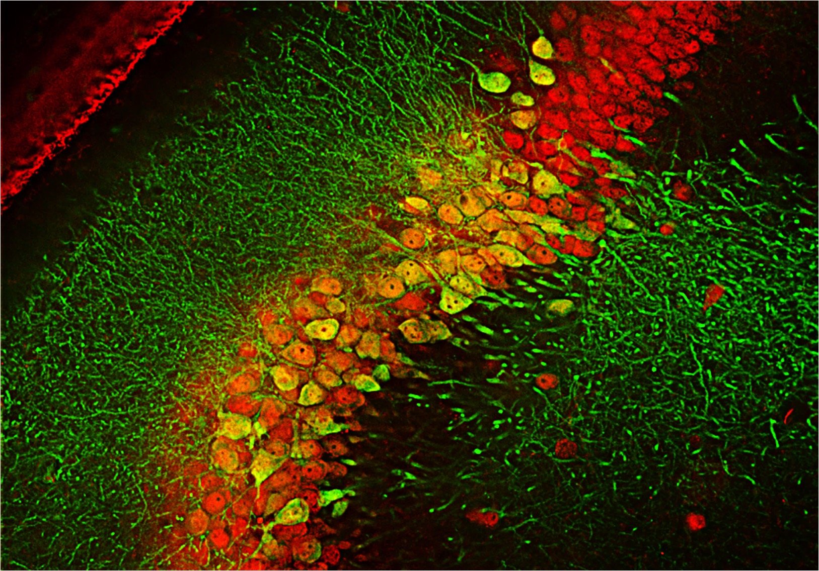 gm3-synthase-deficiency