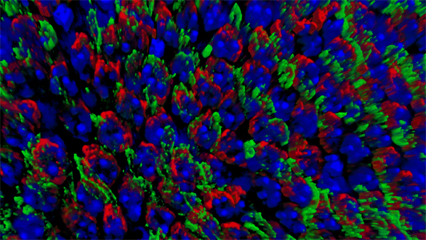 Retinitis Pigmentosa