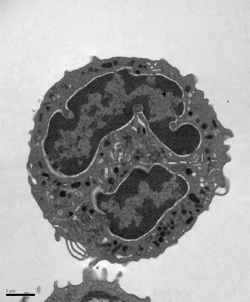 Severe Congenital Neutropenia