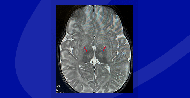 Innovative neurosurgical technique used in Tay-Sachs gene therapy clinical trial