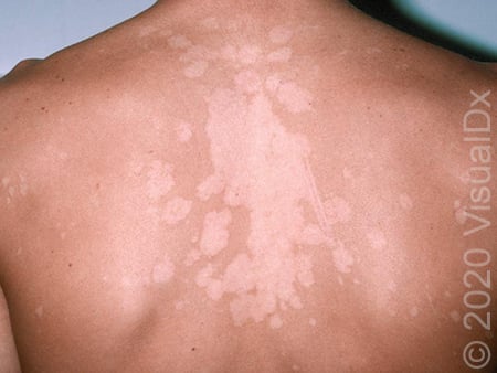 Tinea versicolor_2767.jpg