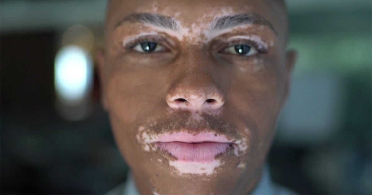 Vitiligo-Research-Participation-Survey.jpg